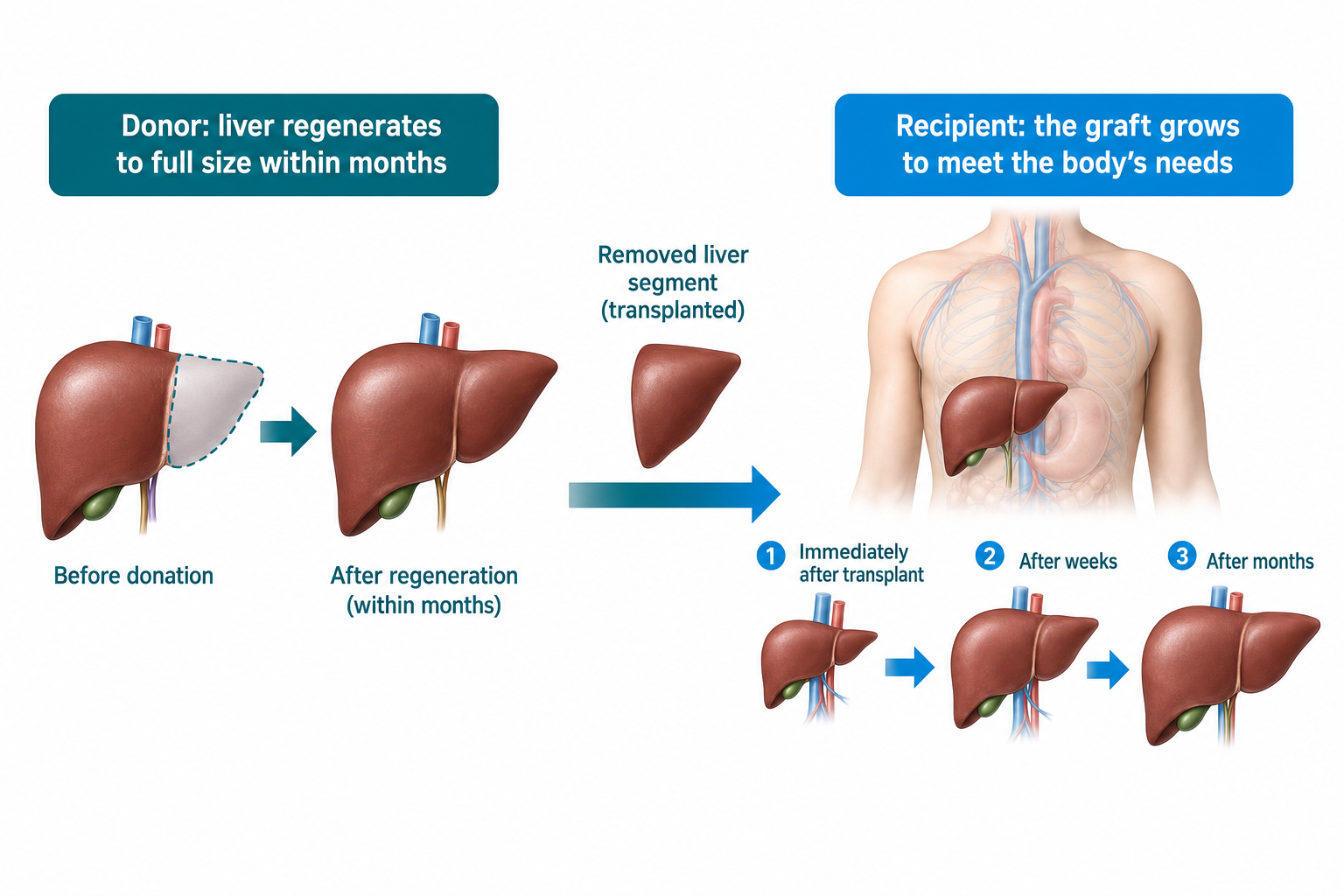 Infographic: liver regeneration in the donor and graft growth in the recipient